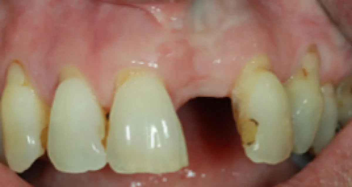 Implant Crowns Before Whitehall