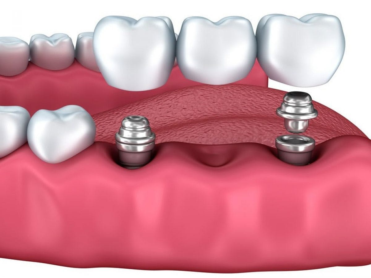 South Molton Multiple Dental Implants