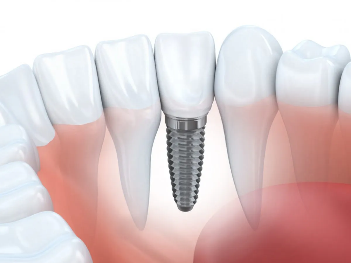 South Molton Single Dental Implants